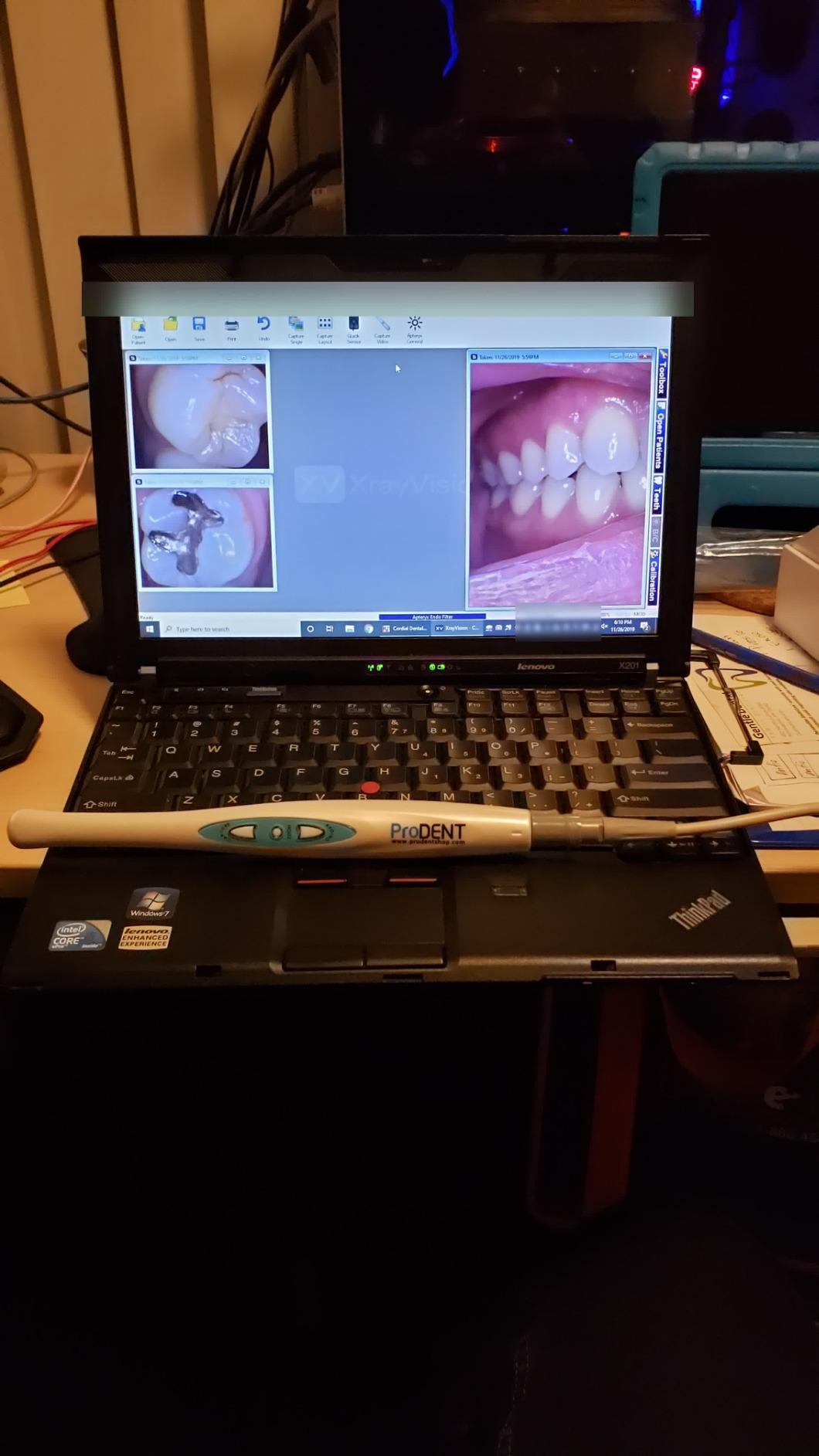 ProDENT HD Intraoral Camera PD760, USB Dental Camera, Capture Button Work with Eaglesoft,Dexis, Carestream, opendental, Apteryx, curvehero and More customer photo 2