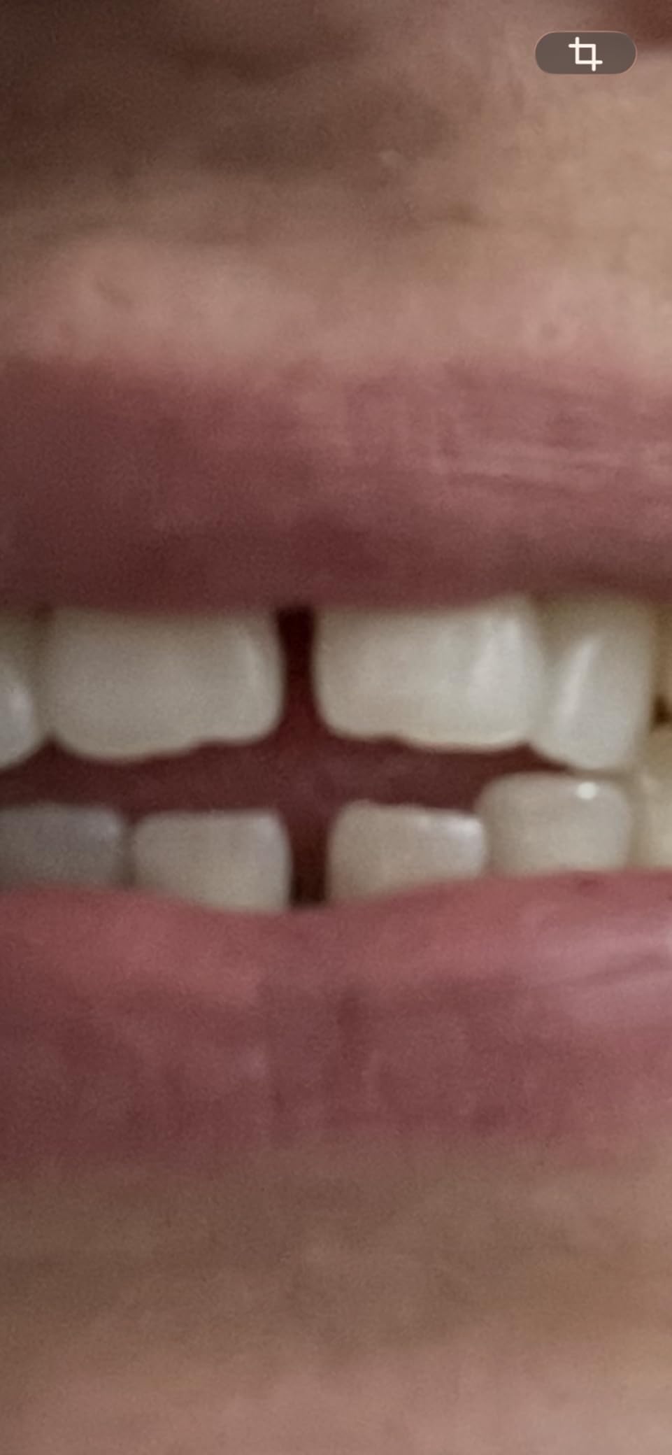 Plaque Remover for Teeth - Tartar Remover for Teeth, Dental Calculus Remover Teeth Cleaning Kit 4 Speed Modes with 4 Replaceable Heads, IPX6 Waterproof with LED Light customer photo 1