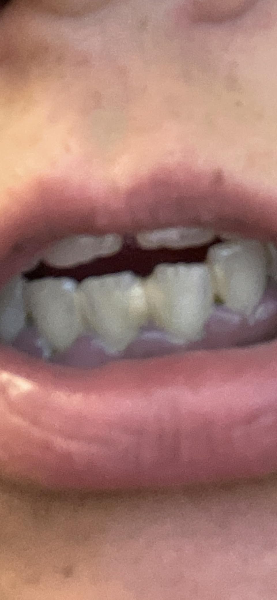 Plaque Remover for Teeth - Tartar Remover for Teeth, Dental Calculus Remover Teeth Cleaning Kit 4 Speed Modes with 4 Replaceable Heads, IPX6 Waterproof with LED Light customer photo 2