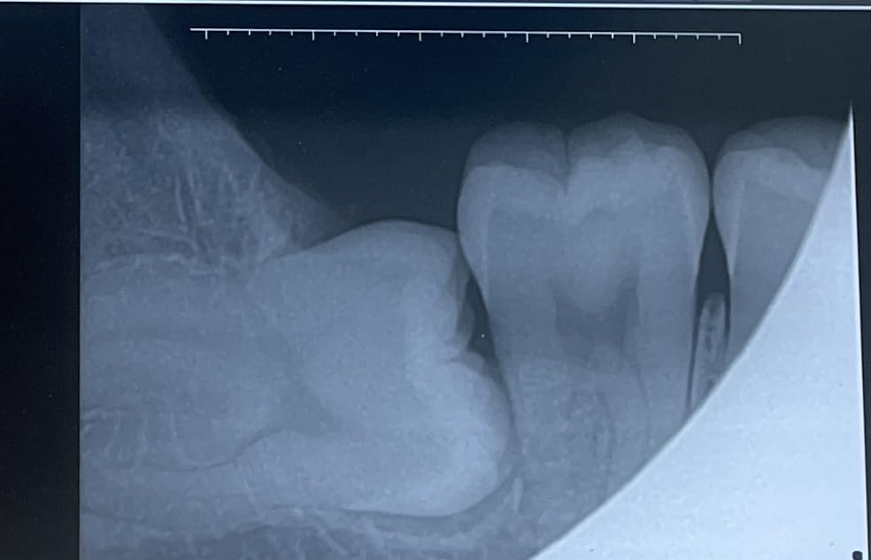 Handheld Dental Xray Machine Portable, Digital Intraoral X-Ray Sensor System for Dental Veterinary Clinic customer photo 1