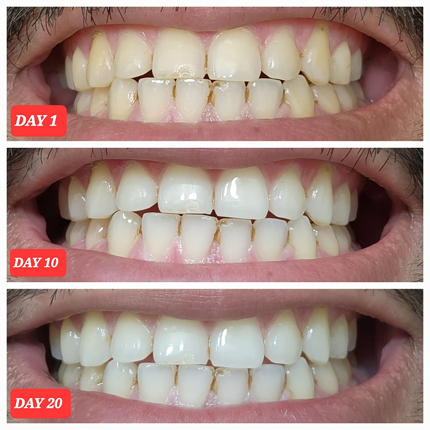 Crest 3D Whitestrips Professional Effects - Teeth Whitening Kit, 22 Treatments customer photo 1