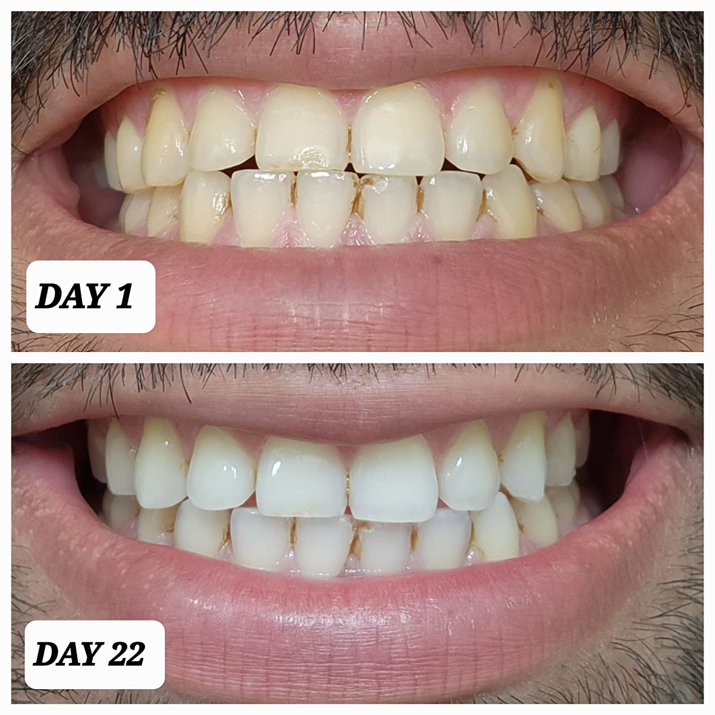 Crest 3D Whitestrips Professional Effects - Teeth Whitening Kit, 22 Treatments customer photo 2