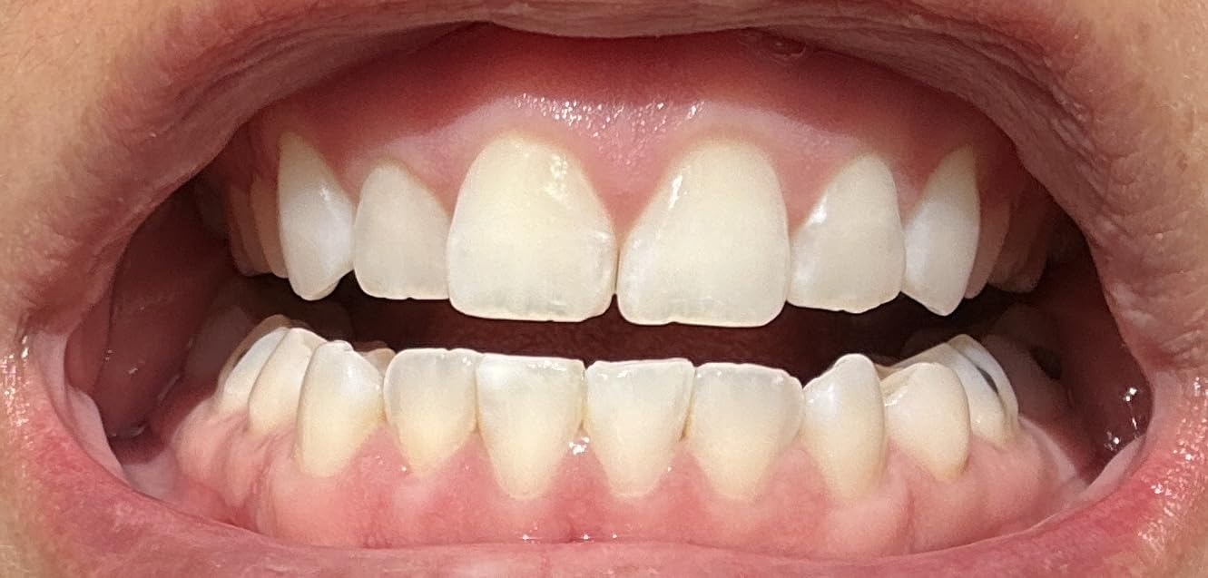 Opalescence Go 15- Prefilled Teeth Whitening Trays - 15% Hydrogen Peroxide - 10 Treatments customer photo 1