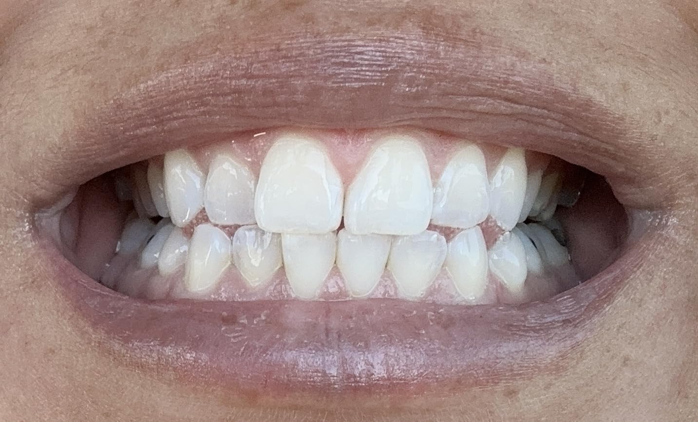 Opalescence Go 15- Prefilled Teeth Whitening Trays - 15% Hydrogen Peroxide - 10 Treatments customer photo 2