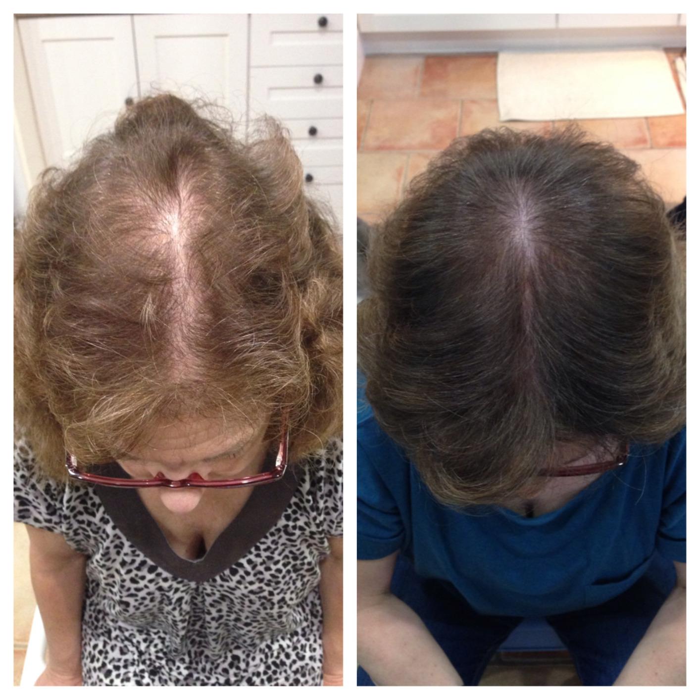 Theradome PRO Laser Hair Growth Helmet LH80 - 100% Laser, No Ineffective LEDs - FDA-Cleared Red Light Therapy for Hair Regrowth 2x Week - Made in the USA customer photo 2