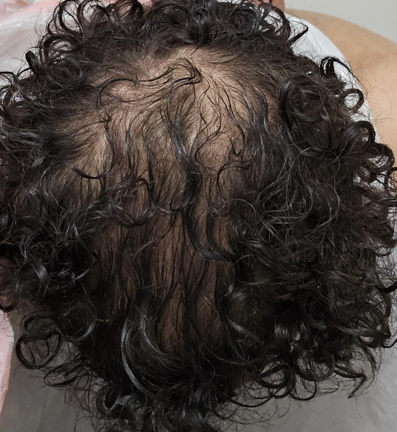 iRestore Essential - Laser Red Light Therapy for Hair Growth - FDA Cleared Hair Loss, Hair Thinning & Alopecia Treatment for Men & Women - Laser Cap for Hair Regrowth Stimulate Denser Fuller Hair customer photo 1