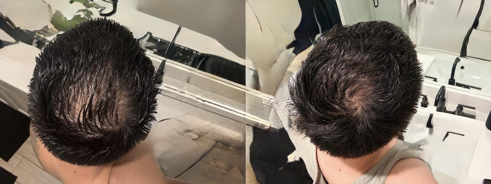 iRestore Essential Laser Hair Growth System + Rechargeable Battery Pack - FDA Cleared Hair Regrowth for Men & Women with Thinning Hair customer photo 1