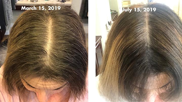 iRestore Essential Laser Hair Growth System + Rechargeable Battery Pack - FDA Cleared Hair Regrowth for Men & Women with Thinning Hair customer photo 2