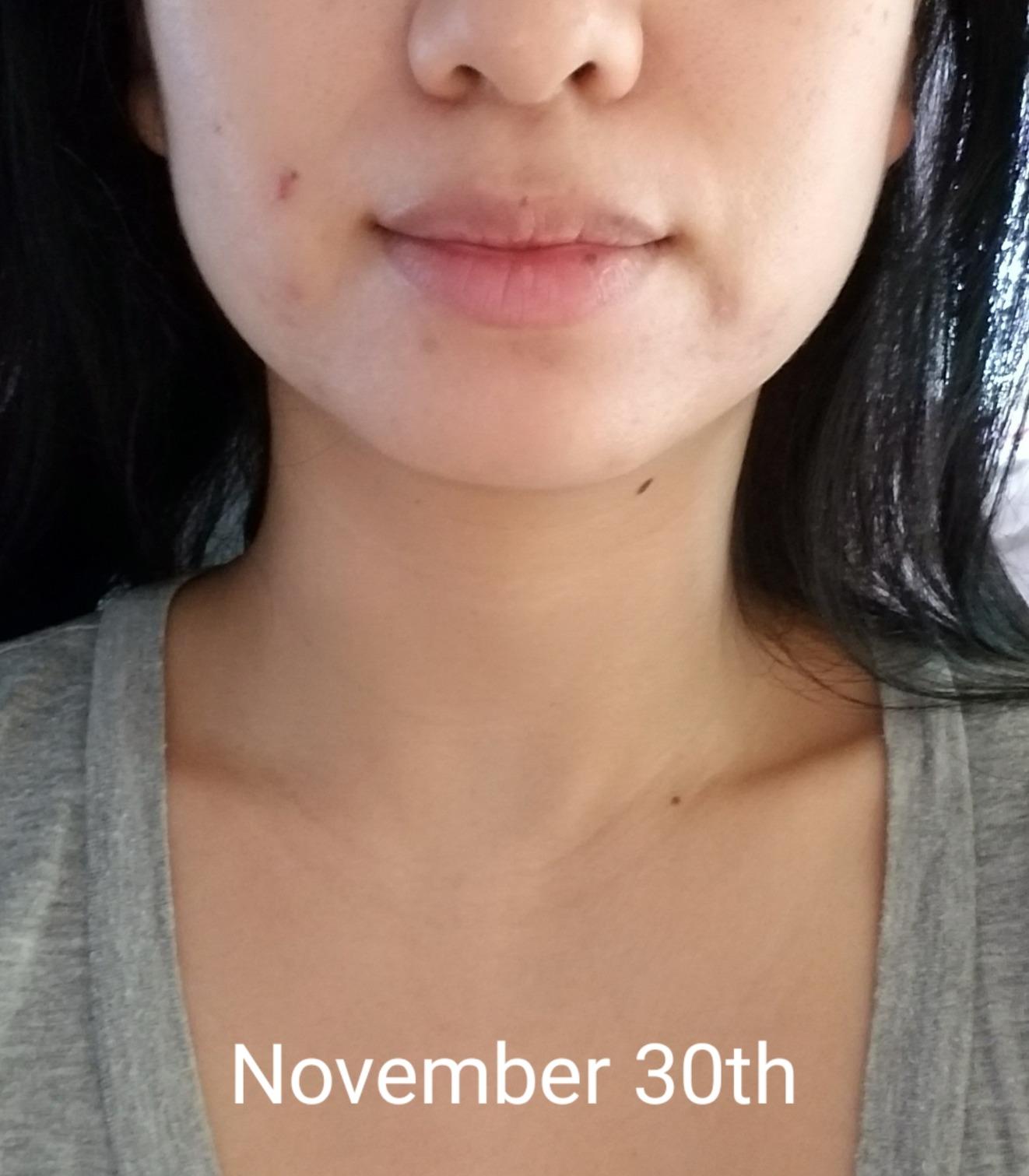 Pure Daily Care NuDerma Handheld Skin Therapy Wand Machine w/Neon - Anti-Aging - Skin Tightening - Wrinkle Reducing - Dark Circles - Clarifying - Hair & Scalp Stimulator customer photo 1