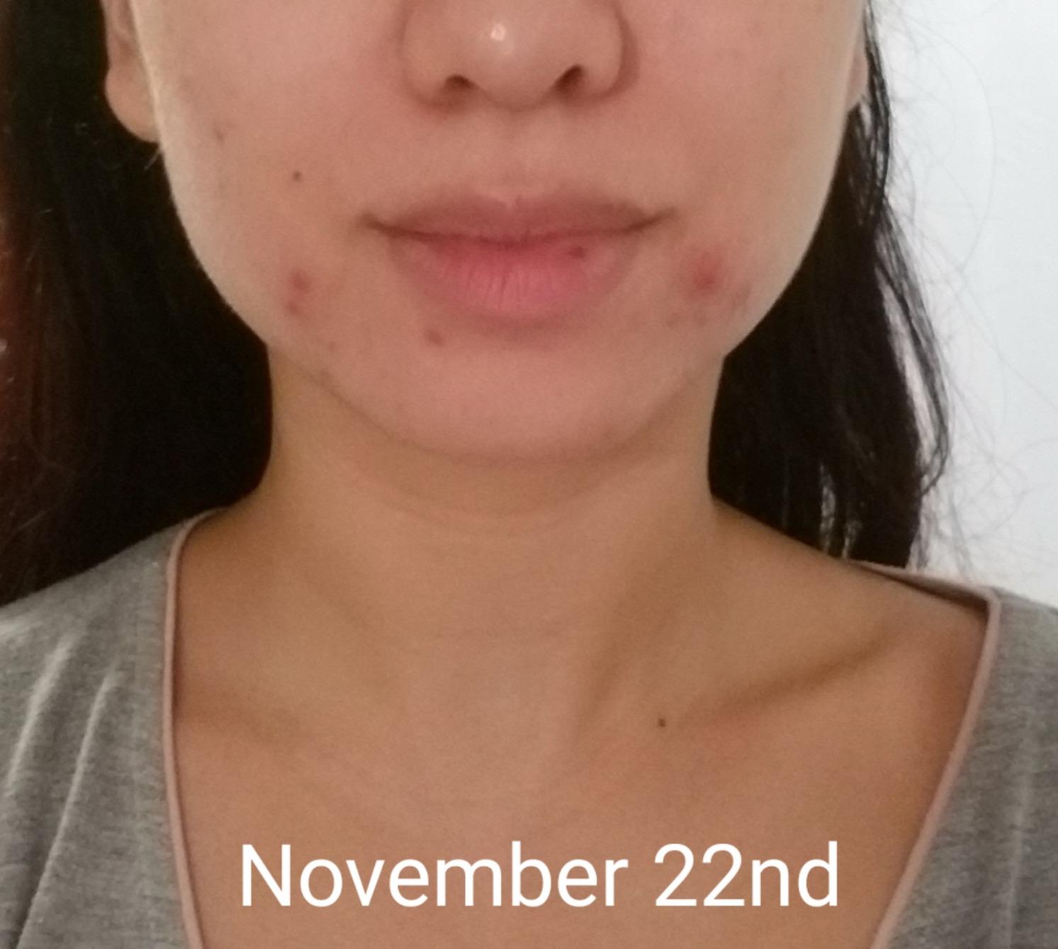 Pure Daily Care NuDerma Handheld Skin Therapy Wand Machine w/Neon - Anti-Aging - Skin Tightening - Wrinkle Reducing - Dark Circles - Clarifying - Hair & Scalp Stimulator customer photo 2