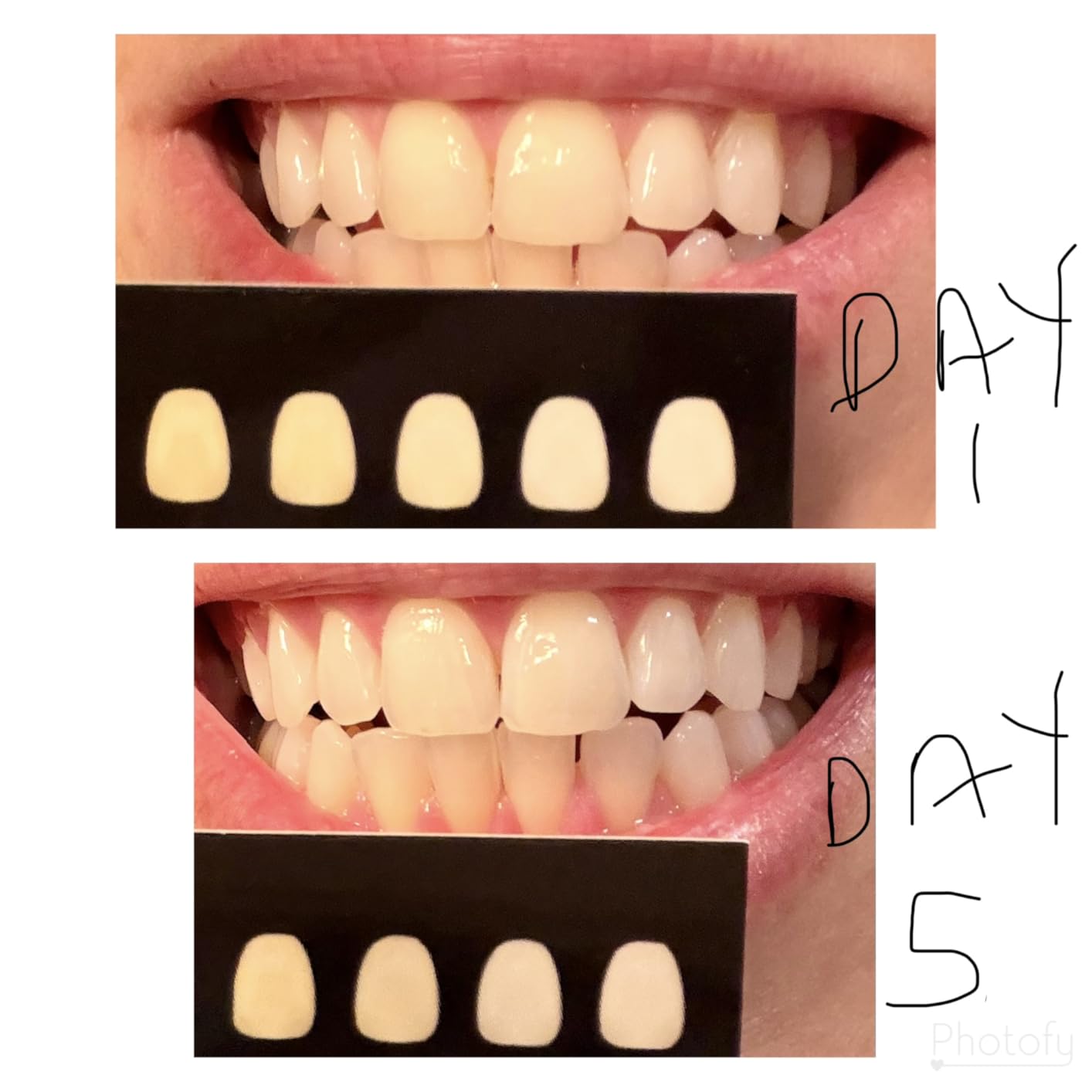 Novashine Professional Teeth Whitening Kit: Advanced Blue LED Light, Concentrated Peroxide Gel customer photo 1