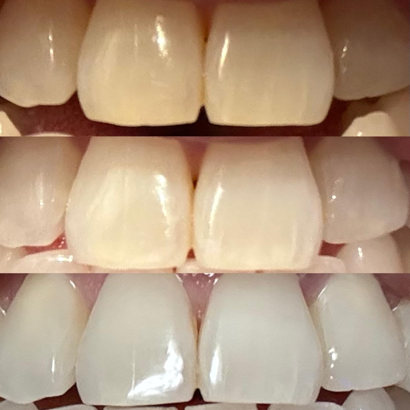 Novashine Professional Teeth Whitening Kit: Advanced Blue LED Light, Concentrated Peroxide Gel customer photo 2