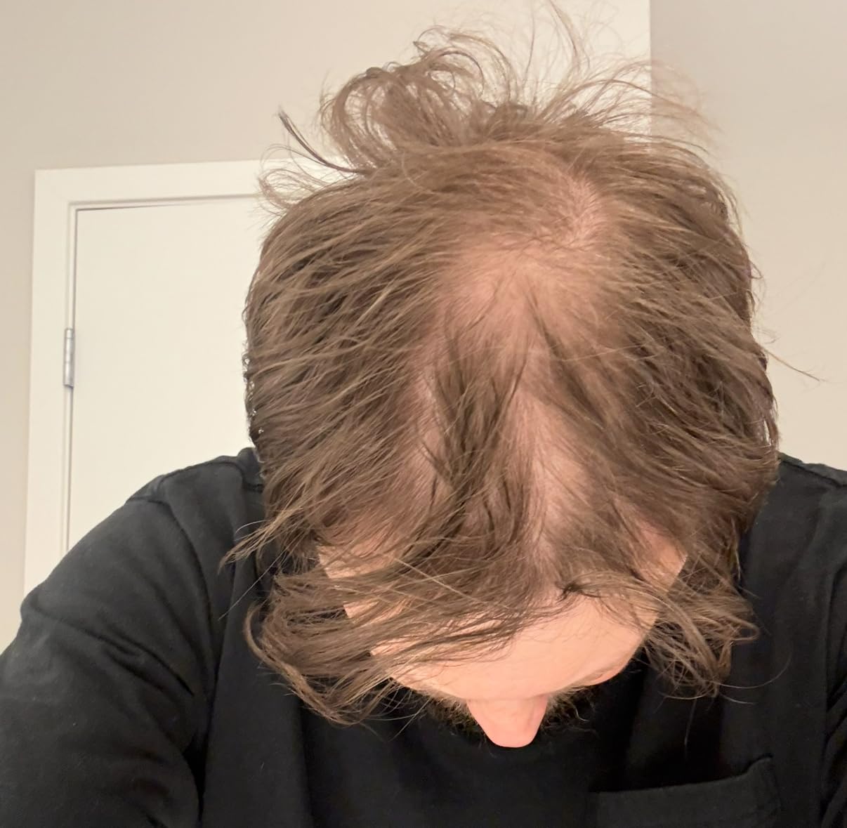 Theradome EVO Laser Hair Growth Helmet LH40 - 100% Laser, No Ineffective LEDs - FDA-Cleared Red Light Therapy for Hair Regrowth 4x Week - Made in the USA customer photo 1