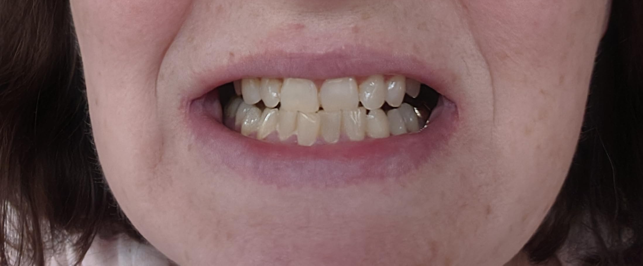 iSmile Teeth Whitening Kit - LED Light, 35% Carbamide Peroxide, (3) 3ml Gel Syringes customer photo 2