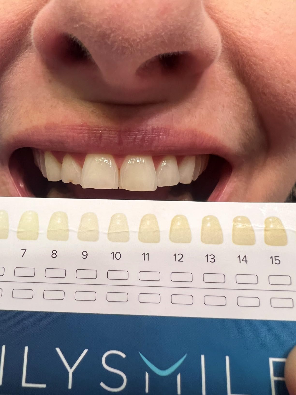 Teeth Whitening Kit with LED - Formulated for Sensitive Teeth, Hands-Free, Waterproof LED Light customer photo 1