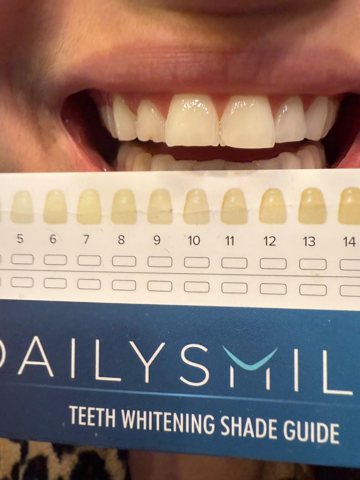 Teeth Whitening Kit with LED - Formulated for Sensitive Teeth, Hands-Free, Waterproof LED Light customer photo 2