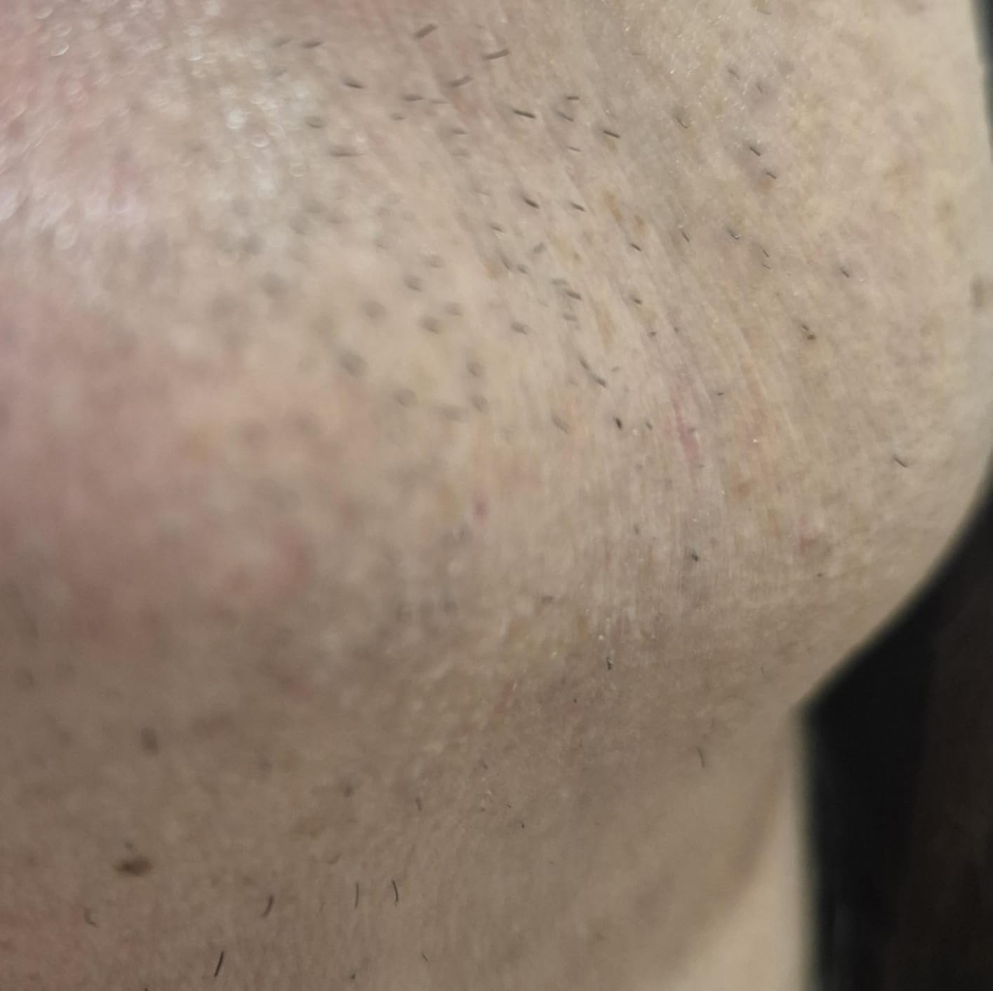 Braun Smart IPL, Skin i-Expert Pro 7, VOGUE's Best Hair Removal Device, IPL Hair Removal for Women and Men, Permanent Laser Hair Reduction At-Home, World's 1st Smart App, 4 Heads, IPL7387 customer photo 2