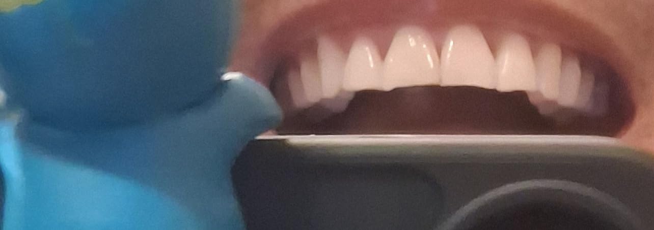 Crest 3D Whitestrips Sensitive & Gentle + LED Light - Teeth Whitening Kit, 1 Light + 14 Treatments customer photo 1