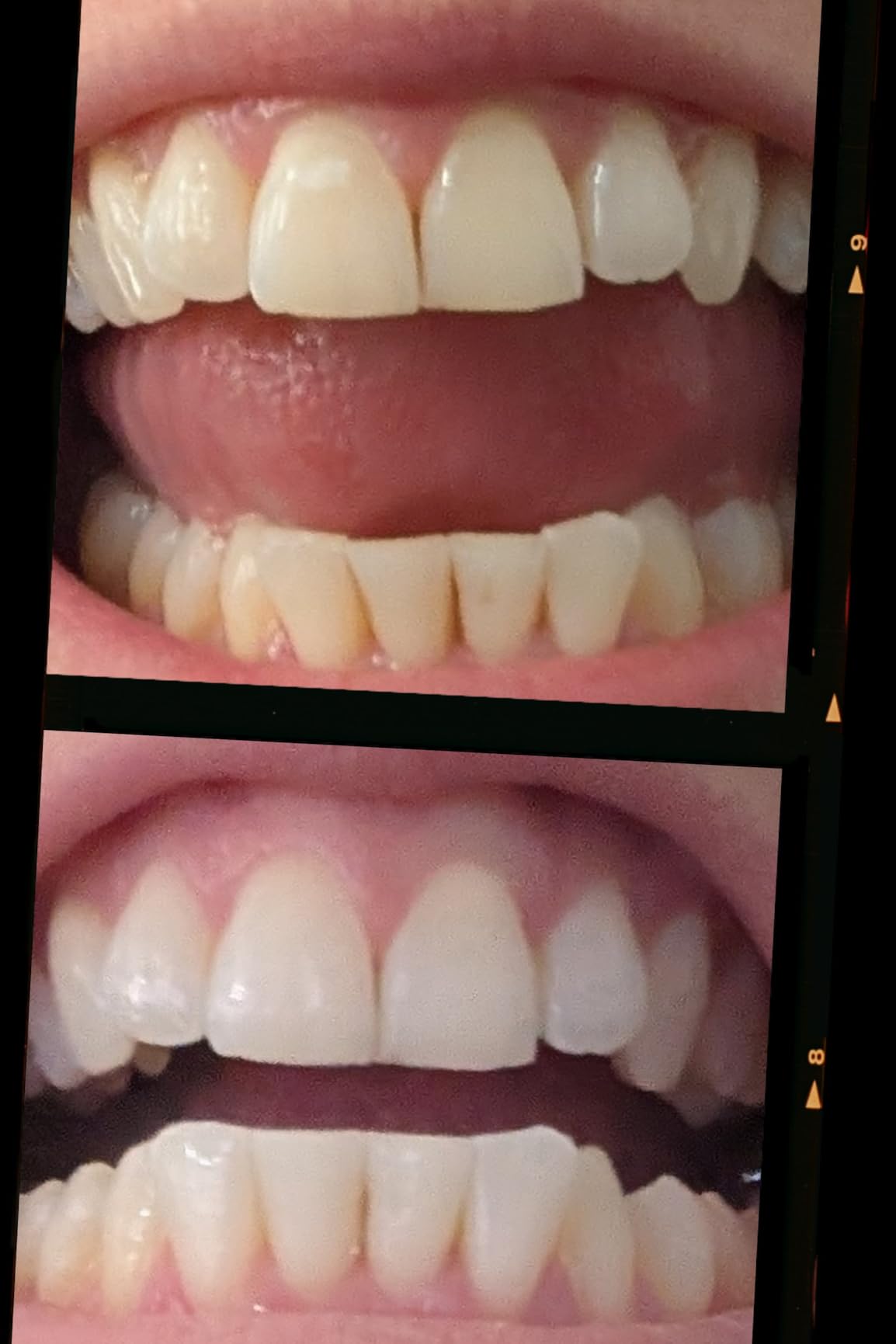 Auraglow Plug-in LED Teeth Whitening Kit - Wired Light Device - 35% Carbamide Peroxide Gel customer photo 1