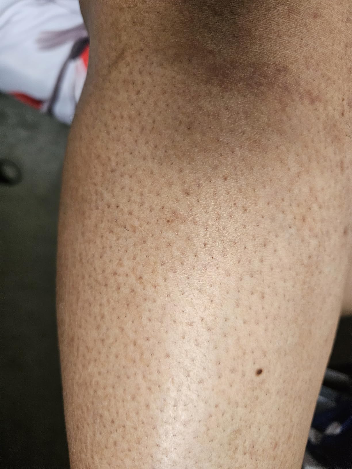 Ulike Laser Hair Removal Device Air 10 Ipl Gift for Women and Men, Ice cool and Permanent hair Reduction for Nearly Painless, Dual Lights, Skin Sensor & USHR Mode Hair Removal in 10mins from Home customer photo 2