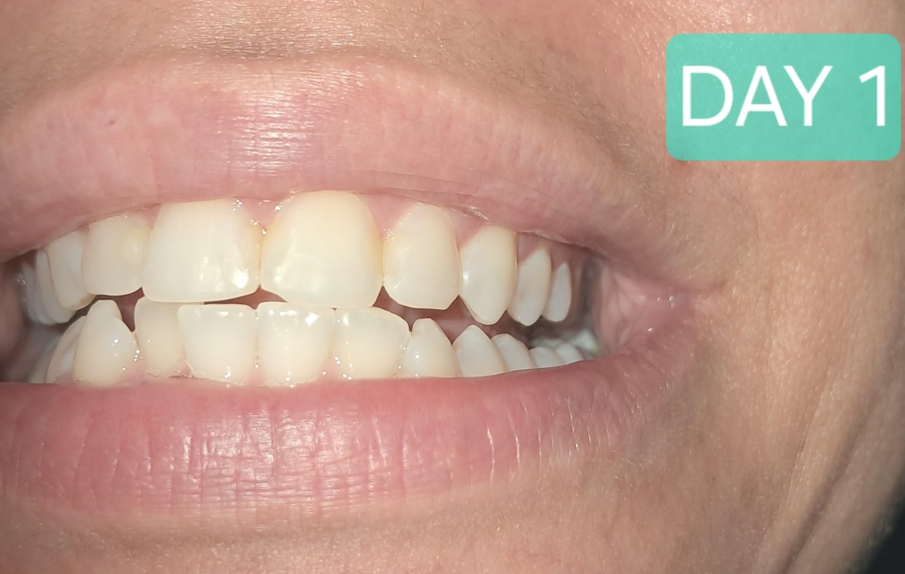 MySmile Teeth Whitening Kit with LED Light, 10 Min Fast Teeth Whitener with 3 x 35% Carbamide Peroxide customer photo 2