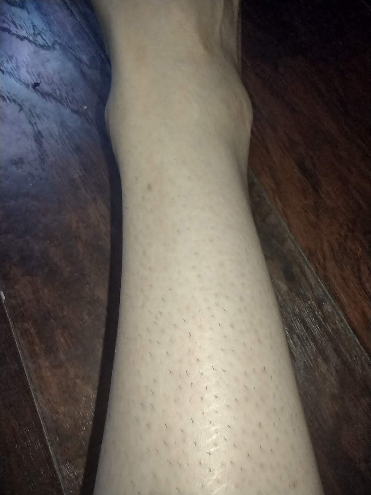 Xsoul Hair Removal with Cooling, Painless IPL Hair Removal Device for Women and Men, at-home Hair Remover for Armpits, Legs, Face, and Bikini Line customer photo 1