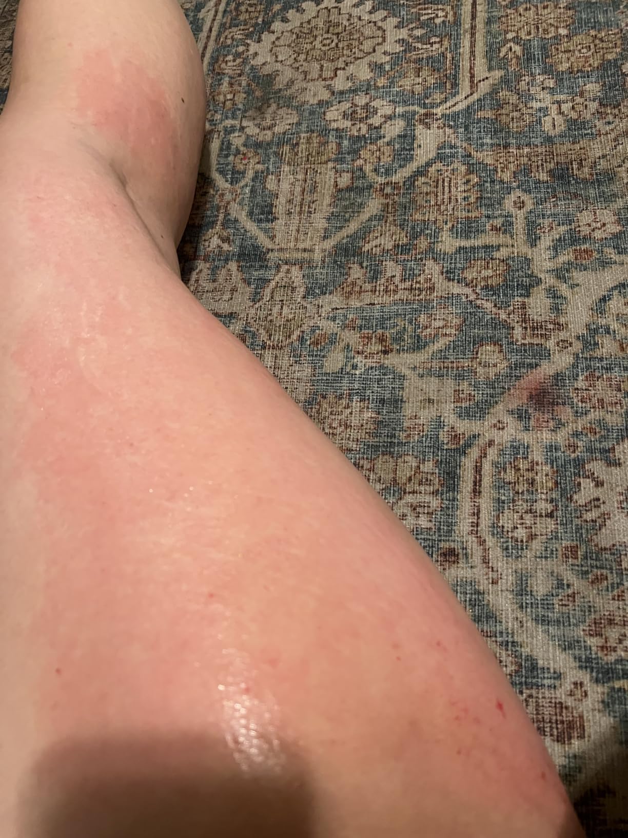 Microneedle Roller Pen for Home Use - Microneeding Derma Roller Pen for Women Men - Micro Needle Roller Pen for Skin Tools-0.24MM customer photo 1