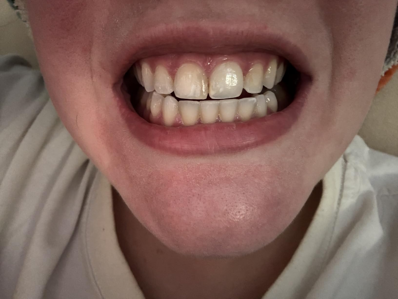 MOON Teeth Whitening Kit, Platinum Teeth Whitener LED Device, 28 Dissolving White Strips customer photo 1