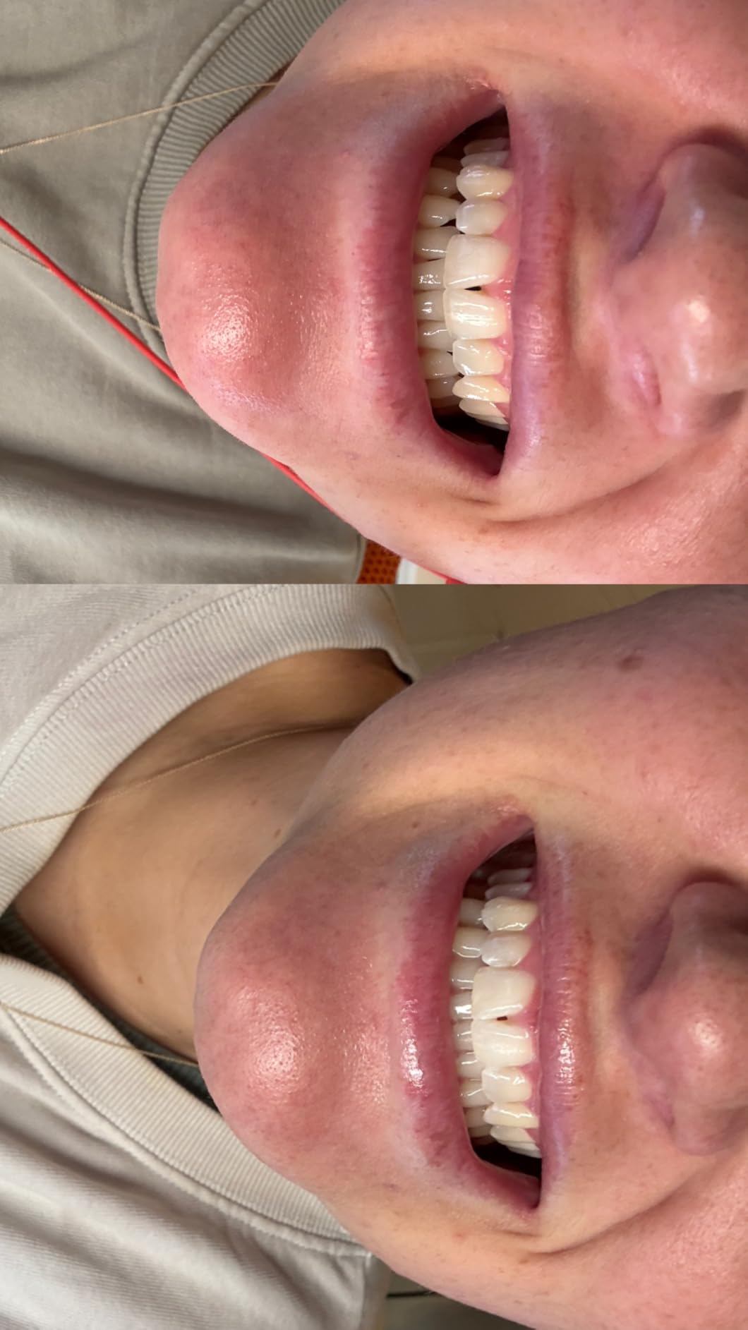 Venus Visage LED Teeth Whitening Kit with 4X 35% Carbamide Peroxide Teeth Whitening Gel Syringes, 2X Remineralization Gel Syringes, Whitener Trays, LED Whitener Device & Shade Guide customer photo 1