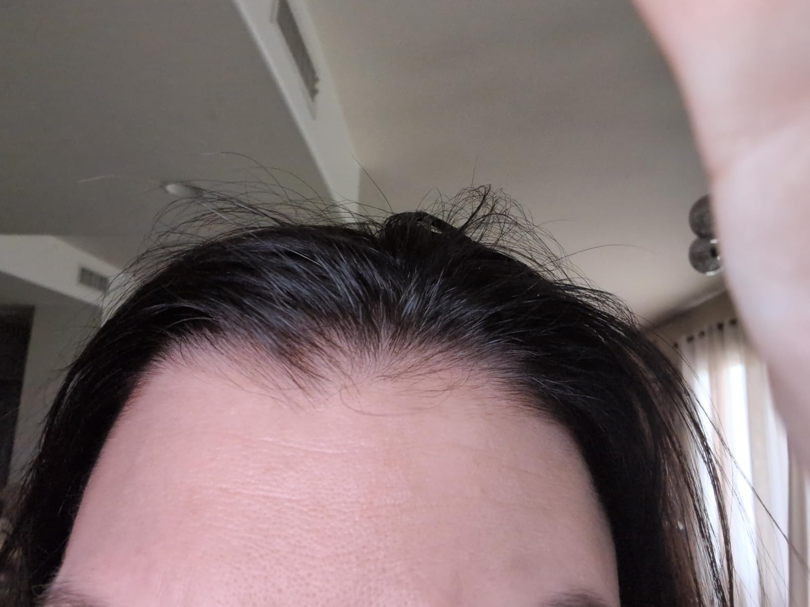 Titanium Microneedles Derma Stamp - Derma Roller Alternative - Microneedle Micro Needle Skin Care Tool - Microneedling Stamp for Men and Women (0.25mm) customer photo 1