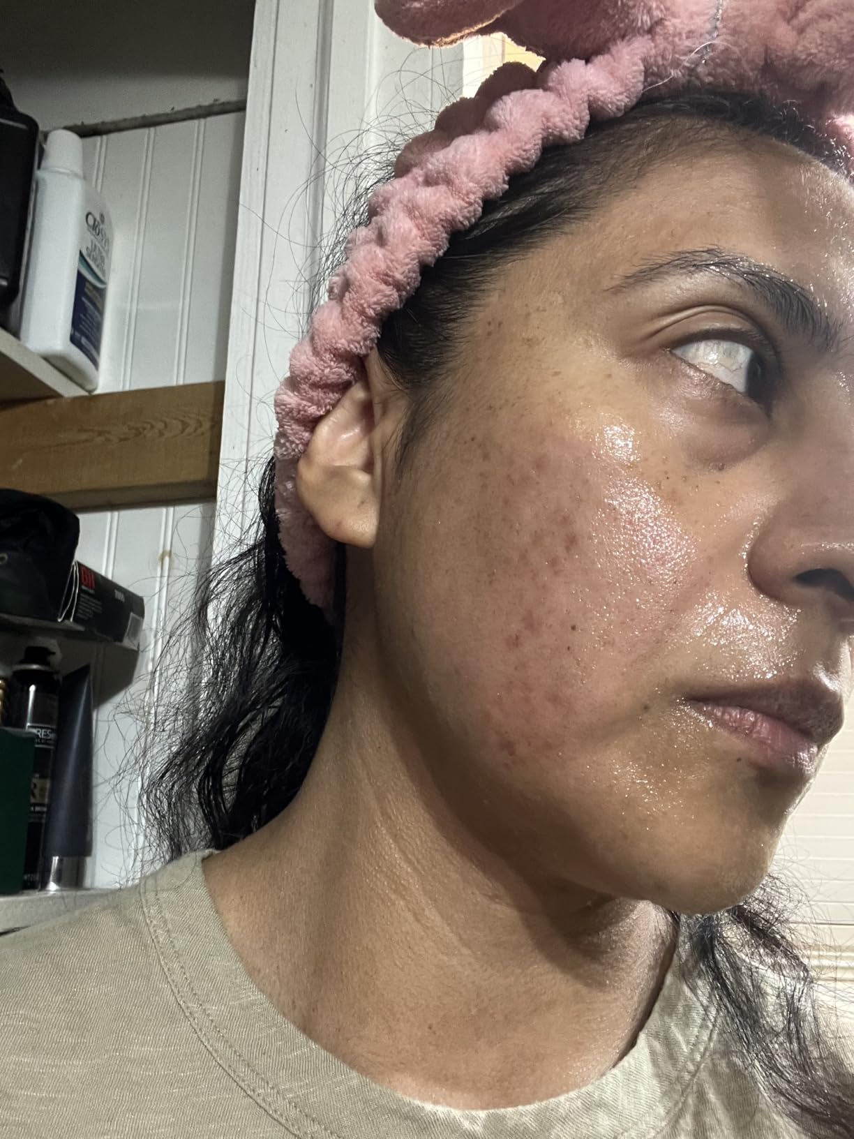 Microneedling Stamp Pen, Derma Stamp Pen, 0.25mm DermaStamp System, Derma Roller Alternative, Microneedle Micro Needle Skin Care Tool for Men Women Home Use customer photo 1