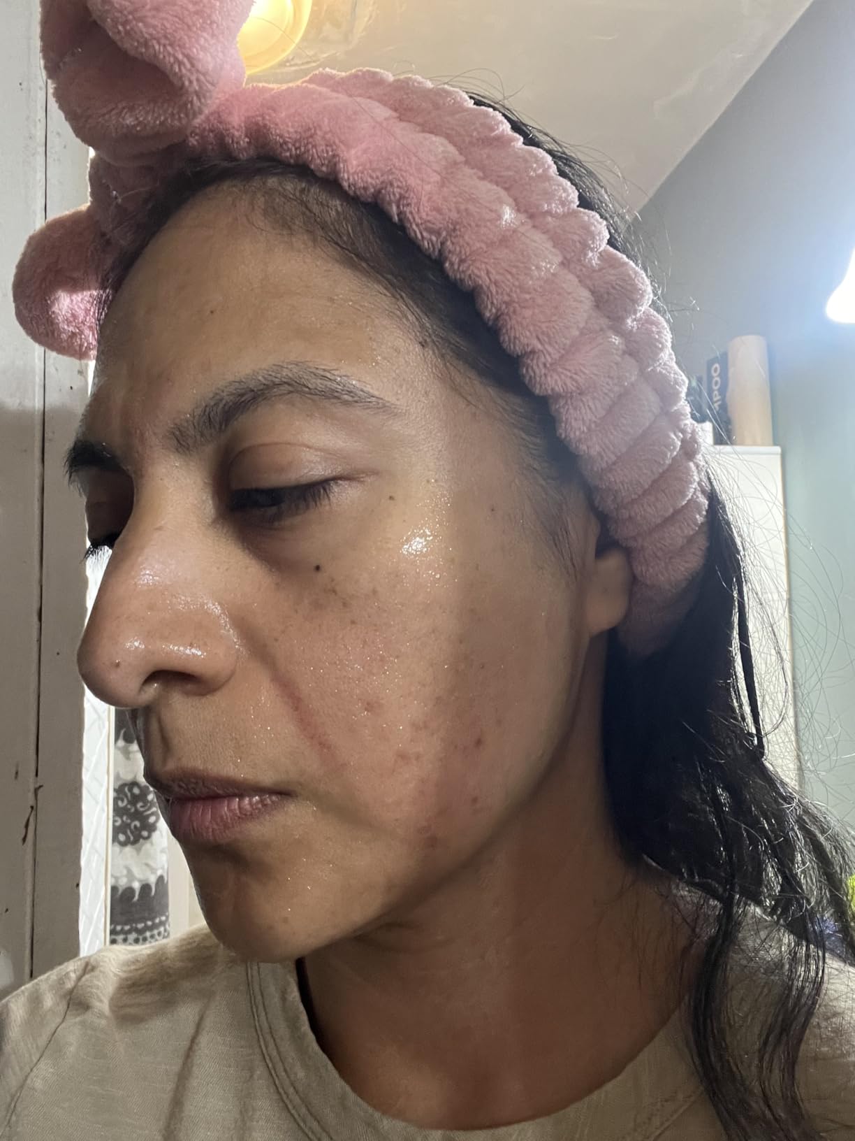 Microneedling Stamp Pen, Derma Stamp Pen, 0.25mm DermaStamp System, Derma Roller Alternative, Microneedle Micro Needle Skin Care Tool for Men Women Home Use customer photo 2