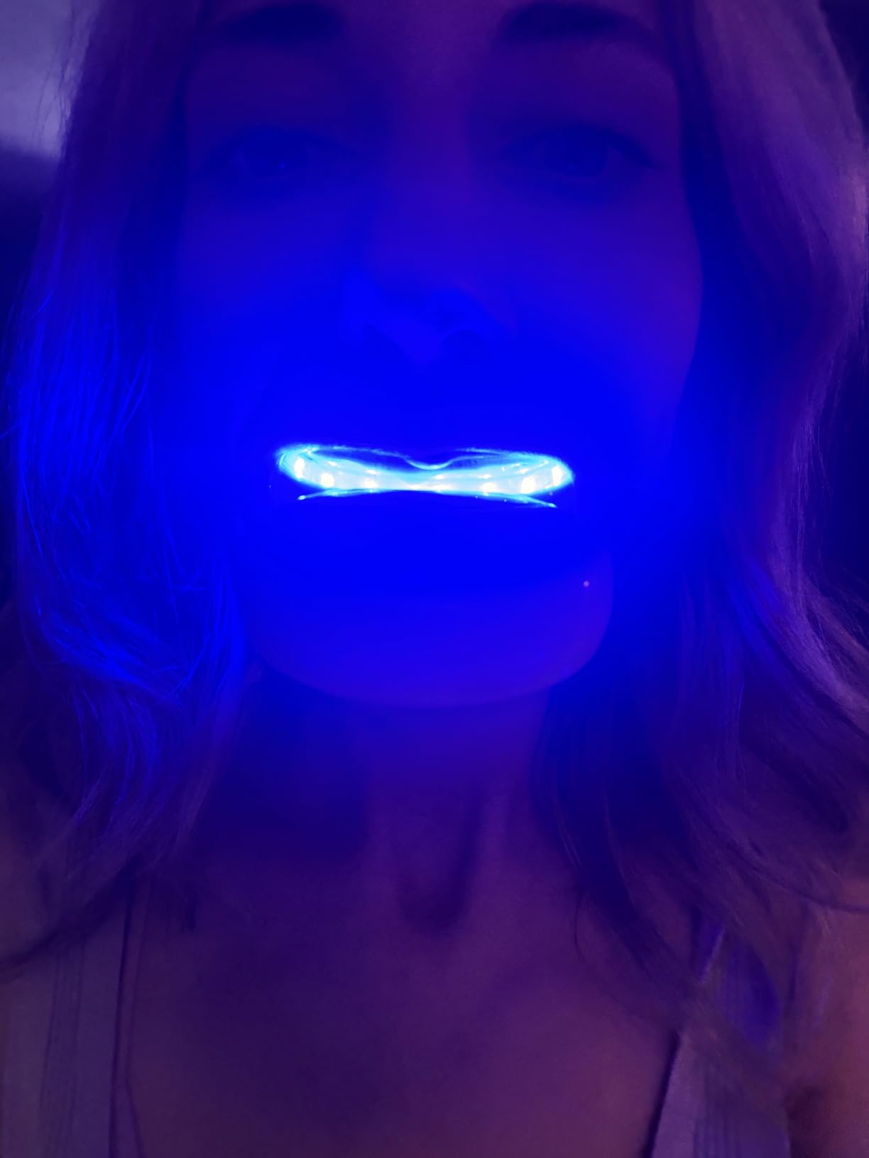 Whitebite Pro Teeth Whitening Kit for Sensitive Teeth - 32X LED Light + 35% Carbamide Peroxide Gel customer photo 1
