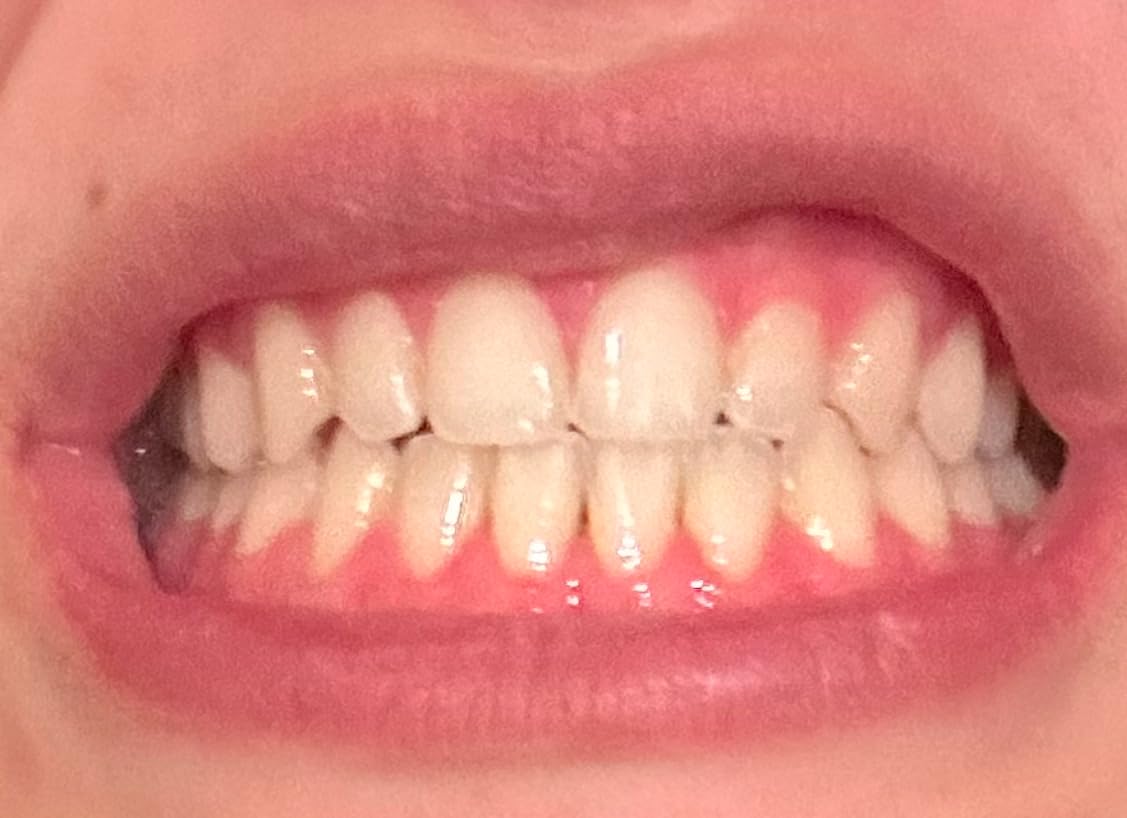 GuruNanda Professional Teeth Whitening Wireless Kit with LED Light & Whitening Pen customer photo 1