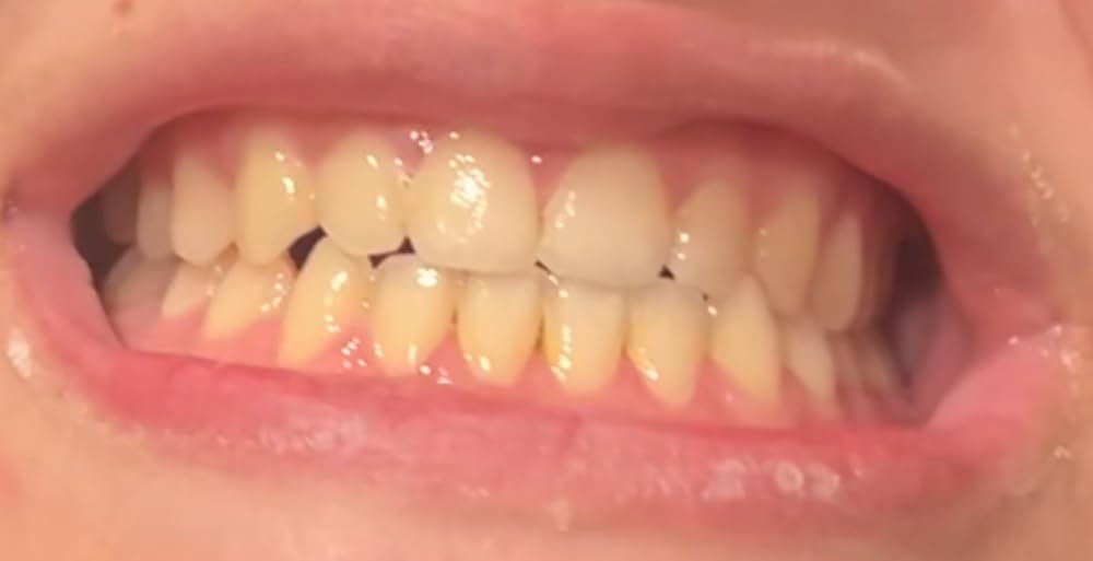 GuruNanda Professional Teeth Whitening Wireless Kit with LED Light & Whitening Pen customer photo 2