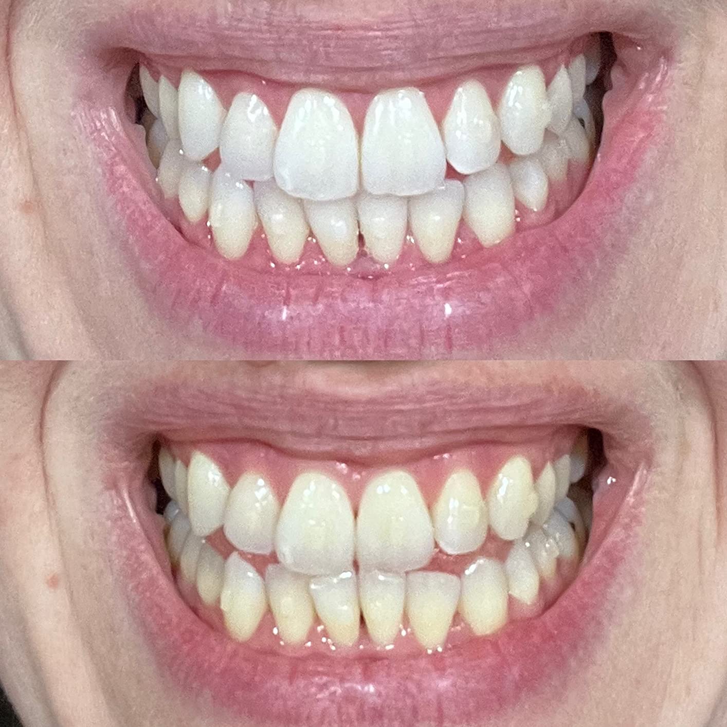 Whitebite Pro Teeth Whitening Kit for Sensitive Teeth | 4 Whitening Gels & 2 Remineralizing Gels customer photo 2