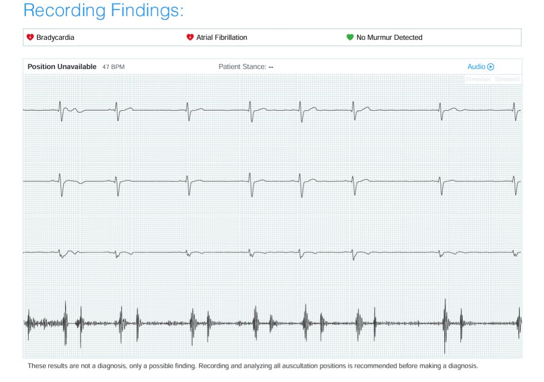 Eko CORE 500 Digital Stethoscope - 40x Amplification, Active Noise Cancellation, 3-Lead ECG, FDA-Cleared AI with Eko+, Full-Color Display, Reimbursement Eligible - Ruby Red, COR501-RED/RED customer photo 2