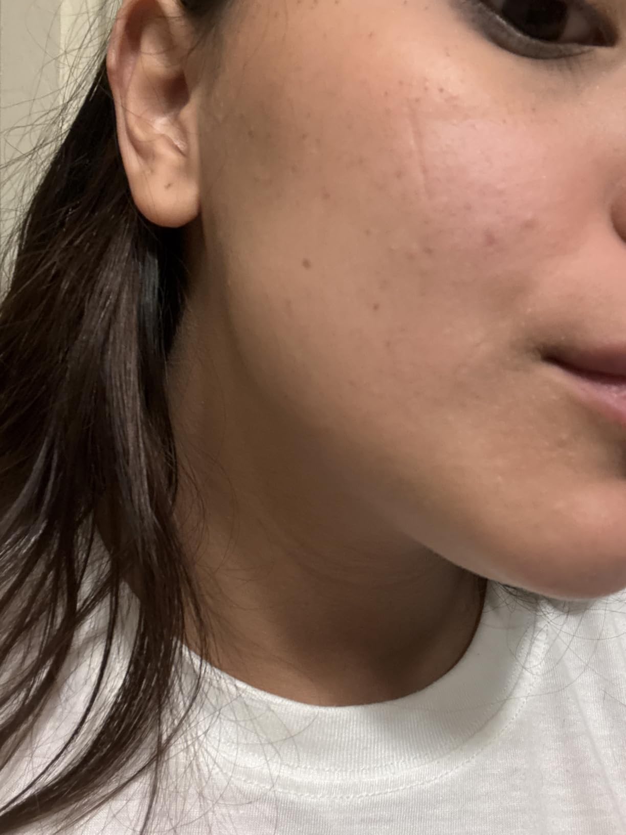 La Roche-Posay Effaclar 1.5% Salicylic Acid Serum, Acne Treatment For Face With Glycolic Acid & Niacinamide, Acne Serum Helps Clear Blackheads, Whiteheads, Pimples & Reduces Post Acne Marks customer photo 1